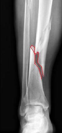lower leg fracture 